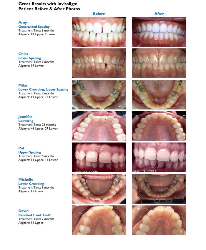 FAQ About Braces and Invisalign Eugene OR Dr W Gray Grieve